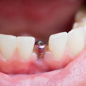A closeup of a single tooth implant’s abutment