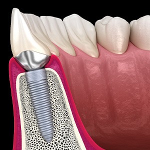 A 3D illustration of a dental implant and its crown