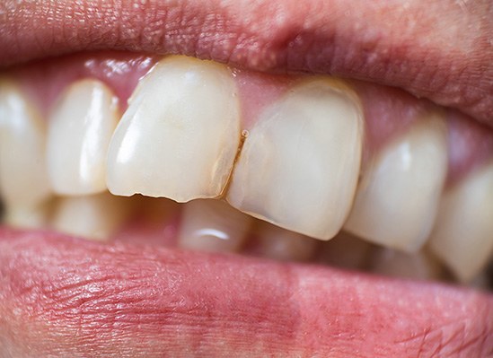 A closeup of a slightly chipped front tooth