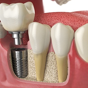 Adult in Colorado Springs smiling at dental implant consultation 
Illustration of a dental implant
