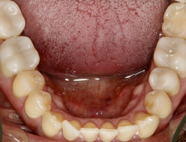 Smile after decay has been treated biomimetically