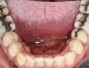 Smile with multiple decayed teeth and silver fillings