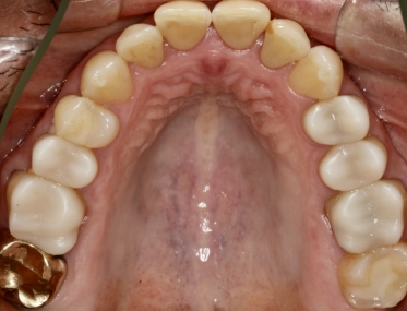 Smile after decay has been treated biomimetically
