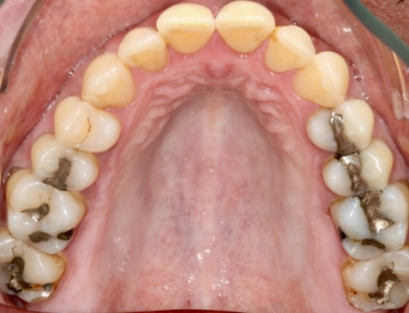 Smile with multiple decayed teeth and silver fillings