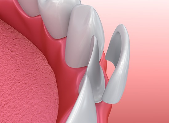 Graphic showing a veneer going over a tooth