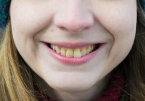 Woman smiling and showing discolored teeth.